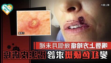 上唇暗瘡