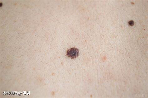 痣形成原因