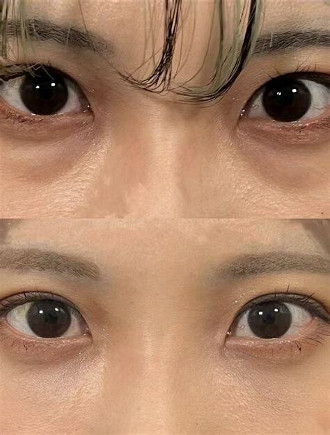 面相眼袋