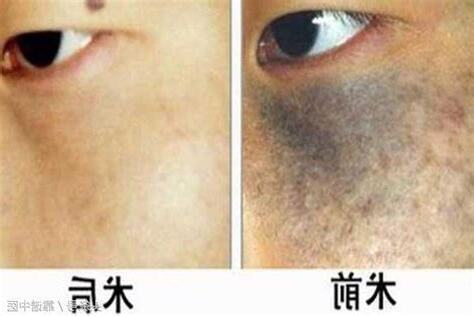 臉上長黑斑