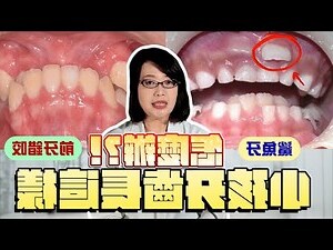 3歲出大牙