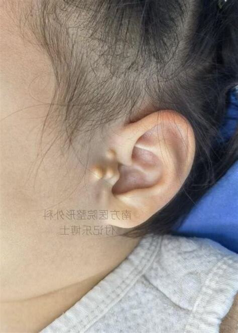 耳屏腫痛