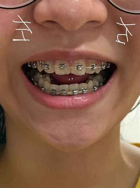 下排牙齒歪斜