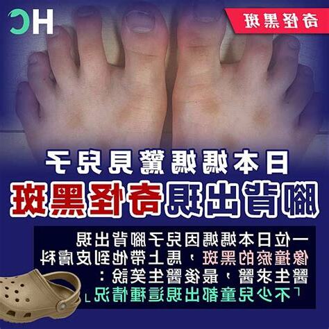 腳背黑斑