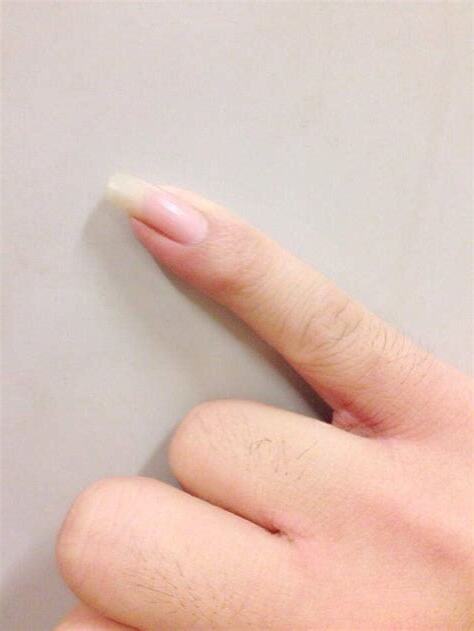 小拇指沒有指甲