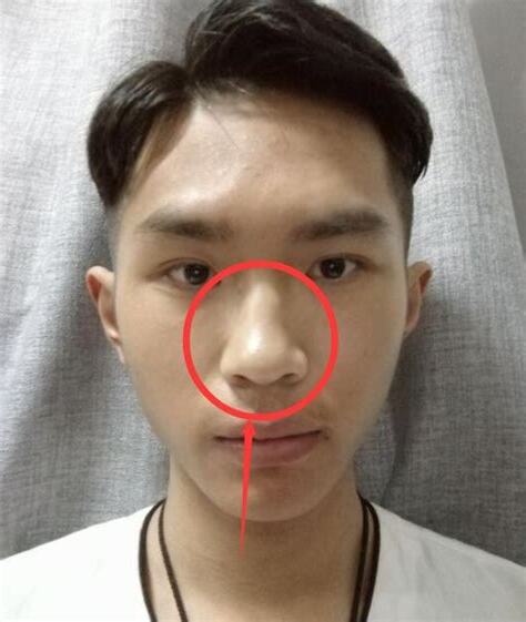 男人鼻子紅