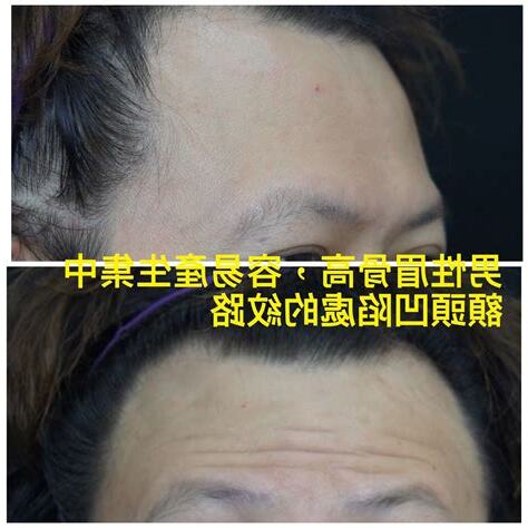 額頭兩側凹陷