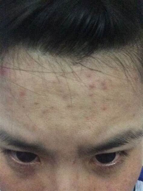 眉尾痘痘