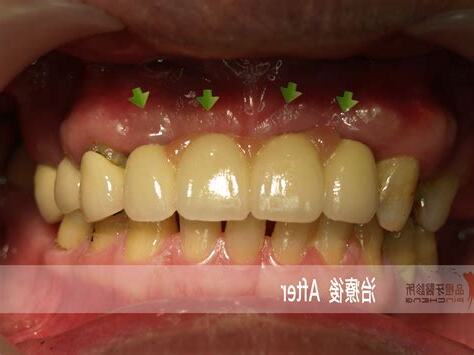 門牙大顆