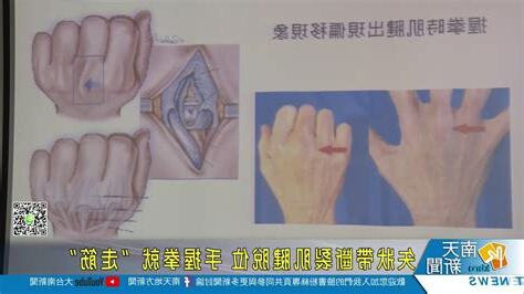 矢狀帶斷裂