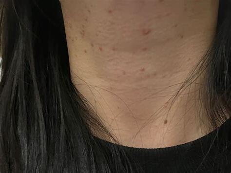 脖子長一根毛