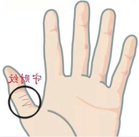 大拇指第二節橫紋