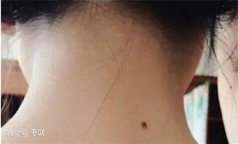 奶上有痣