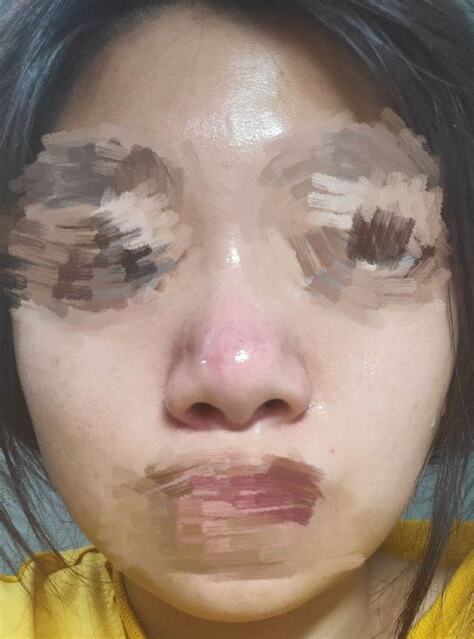 鼻頭泛紅