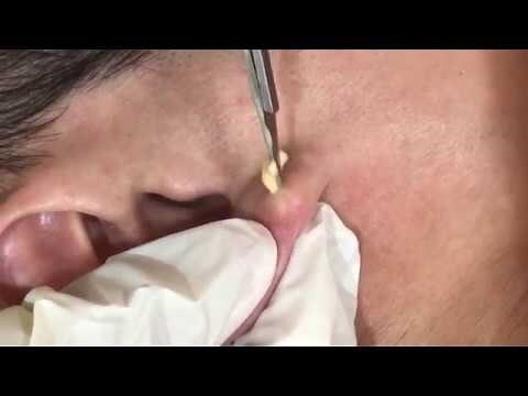 耳垂脫皮