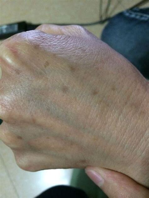 手臂出現黑斑