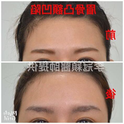 額頭兩側凹陷