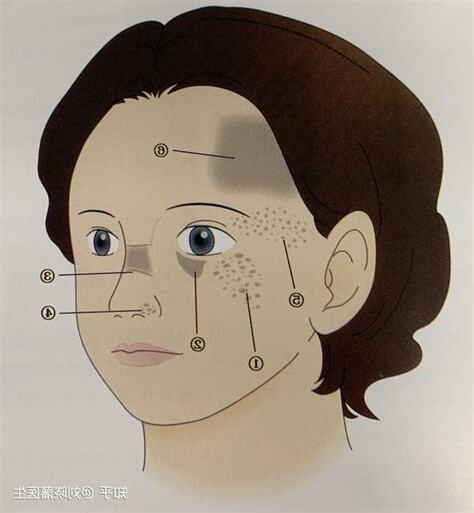 顴骨斑面相