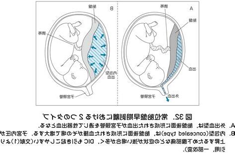 胎盤剝離後期