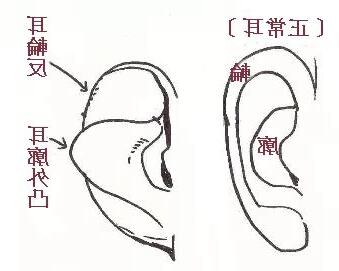 反廓耳