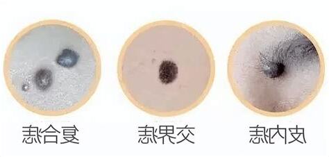 突然長一顆痣