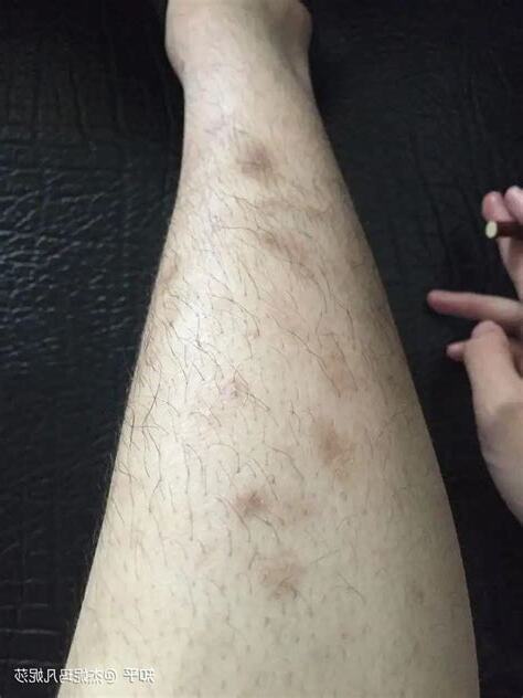 屁股有斑