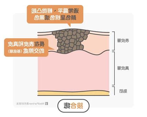 接合痣