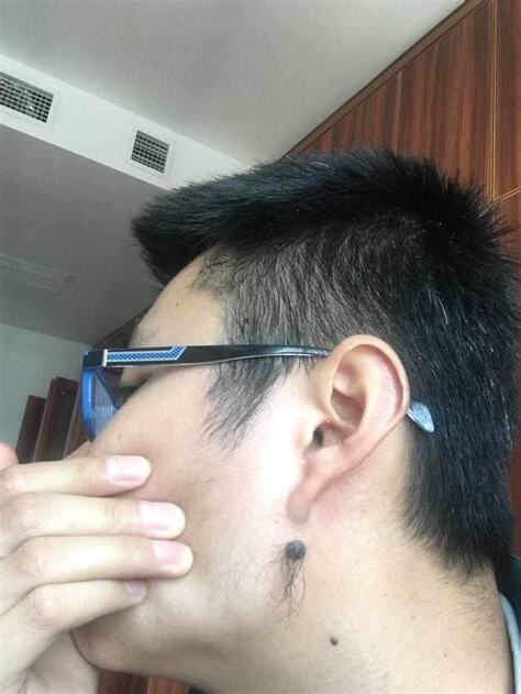 痣為什麼會長毛