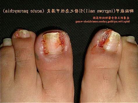 藥腳意思