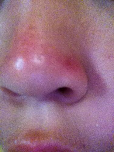 鼻子突然紅紅的