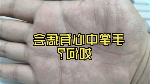 手掌中心有痣