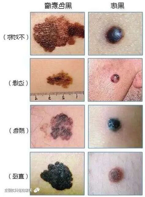 屁股很多痣