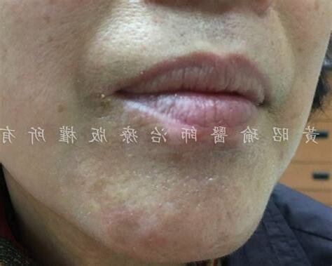 臉上長白毛拔掉