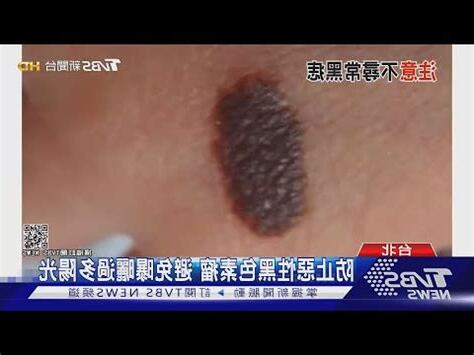 痣的生成