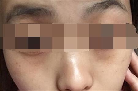 眼下長斑