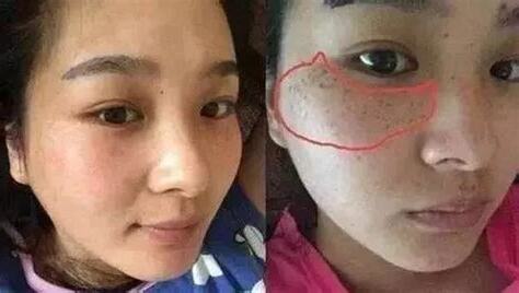 鼻子長斑