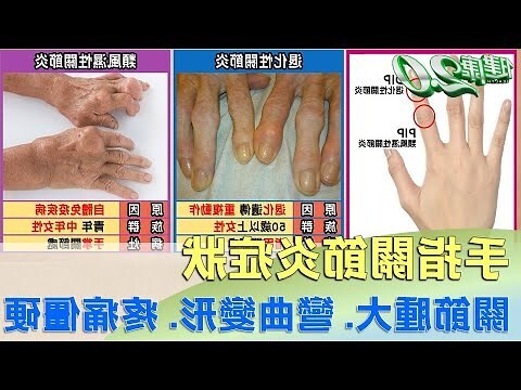 食指彎曲