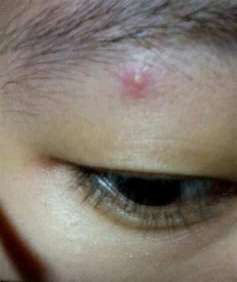 眼皮長痘痘代表什麼