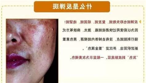 臉上色斑