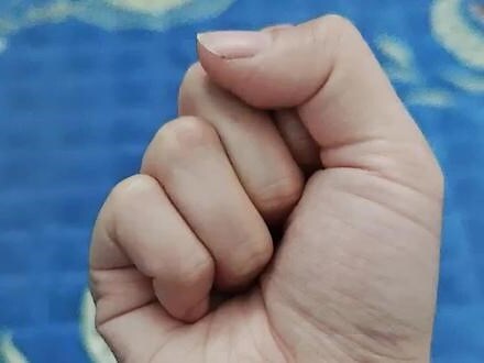 左手掌突然长痣