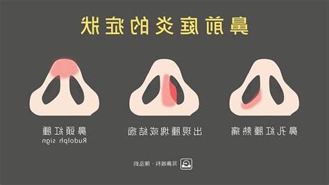 鼻頭突然紅紅的