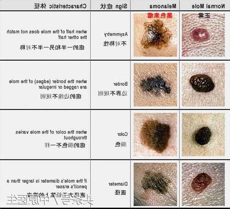 陰部長痣
