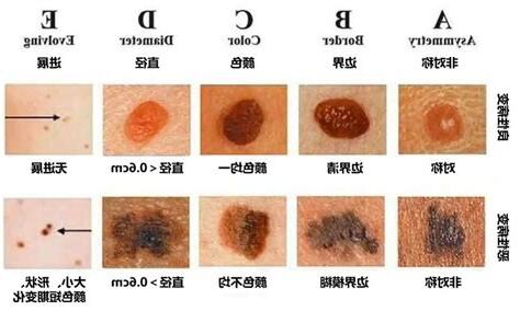 手臂長黑痣