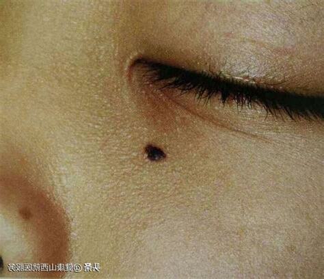 下顎痣