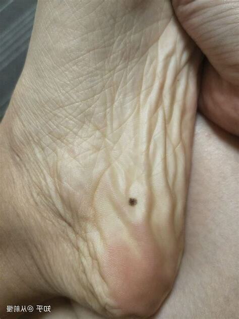腳底痣