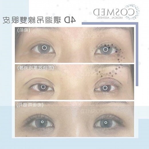 三層眼皮面相