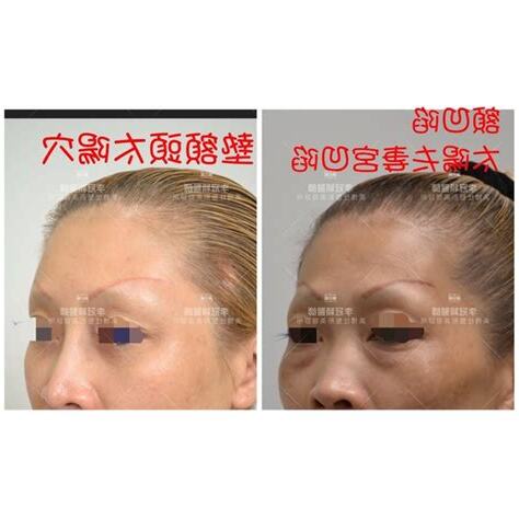 如何讓額頭發亮
