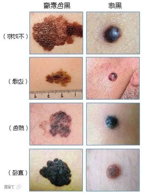 黑色的痣