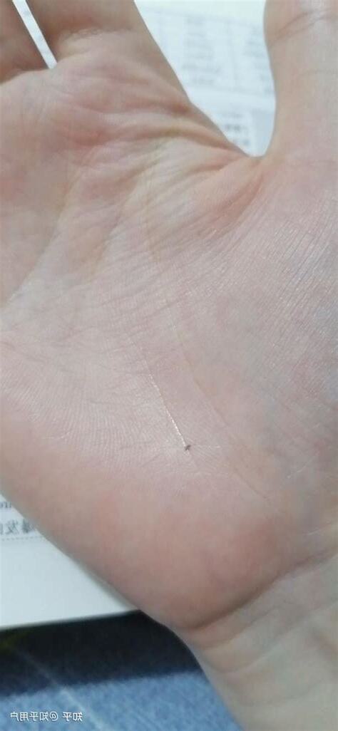 左手突然長痣