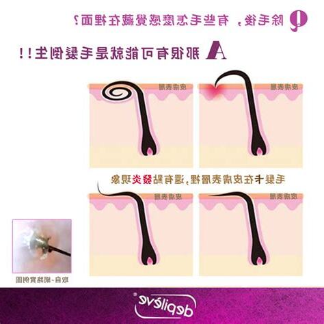 毛髮倒生原因